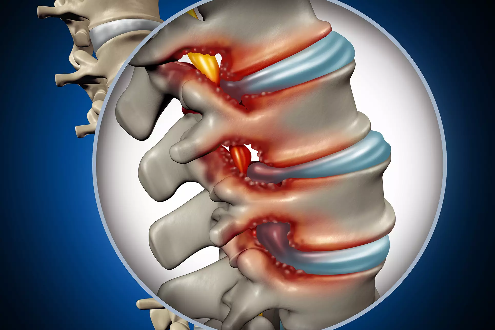 Omurga Tümörleri Cerrahisi