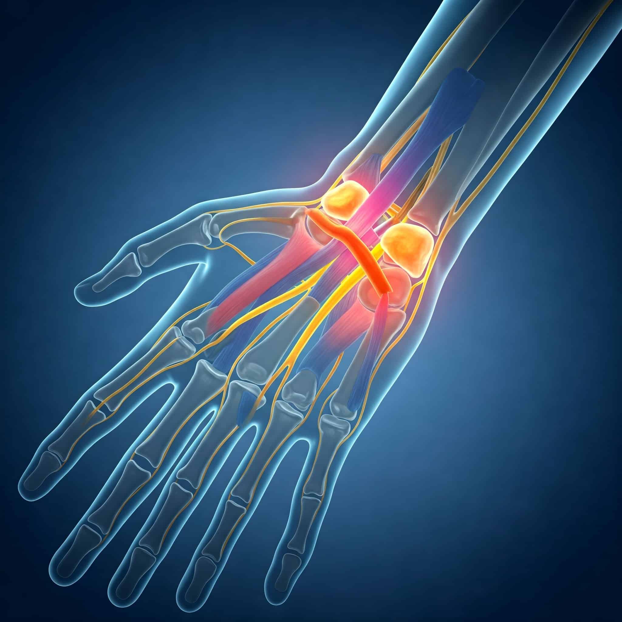 Periferik Sinir Sıkışmaları (Karpal Tünel vb.) Cerrahisi
