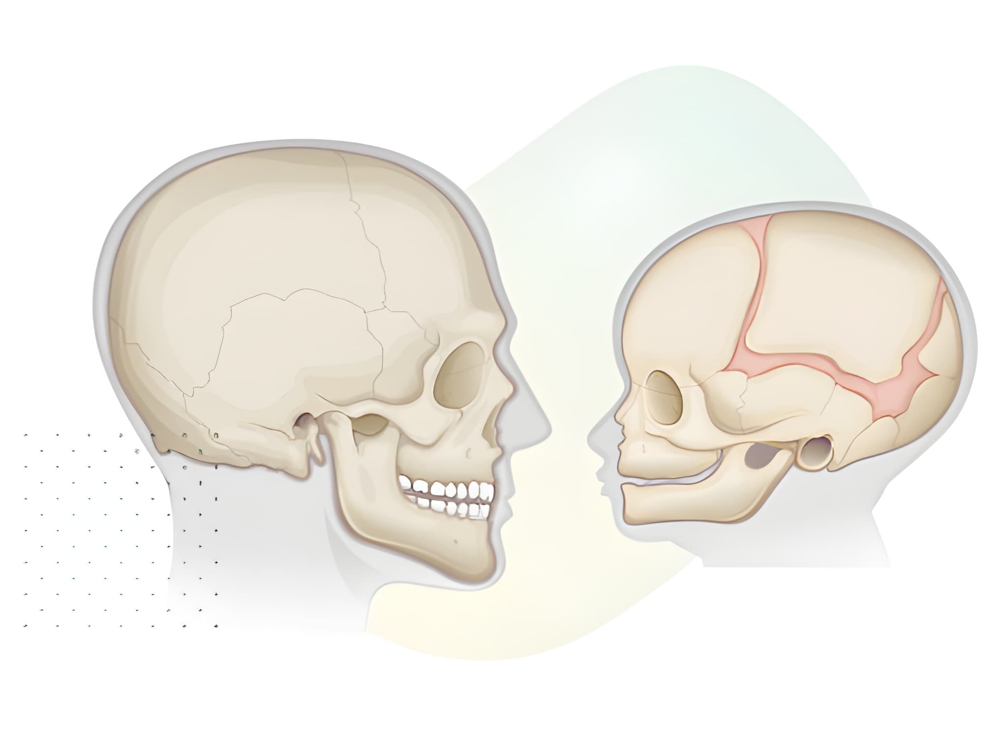 Kafatasının Gelişimsel Şekil Bozuklukları (Kraniyosinostoz)